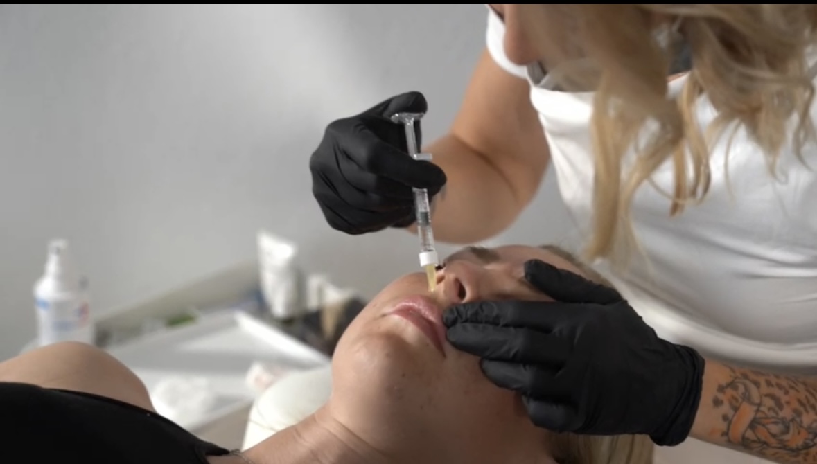 Lippenvolumen, Lippenvolumen aufbauen mit Hyaluronsäure, Lippenvergrößerung, Russian Lips, Kinnaufbau, Wangenaufbau, Hyaluronsäure, zwischen Rosenheim und München, bei Bad Aibling und Bruckmühl