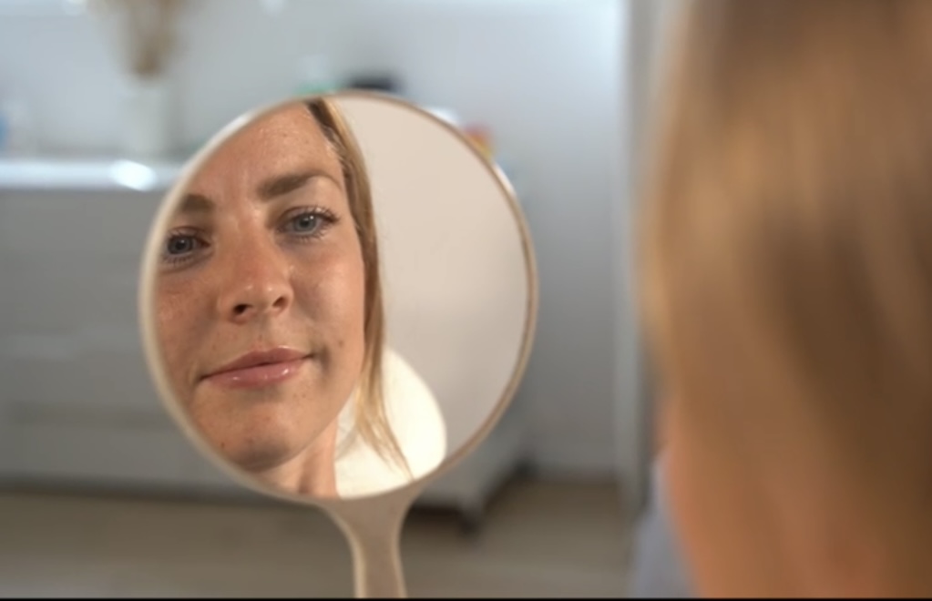 Lippenvolumen, Wangenknochen, Hyaluronsäurebehandlung, Hyaluronsäure Filler, Rosenheim, München, bad Aibling, Kolbermoor, Botox, Botoxbehandlung